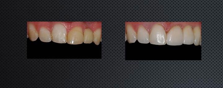 implant crowns